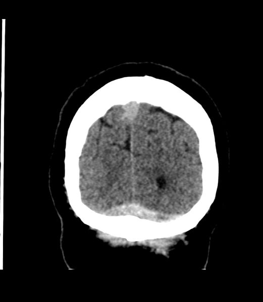File:Cerebral dural venous sinus thrombosis (Radiopaedia 86514-102575 Coronal non-contrast 49).jpg