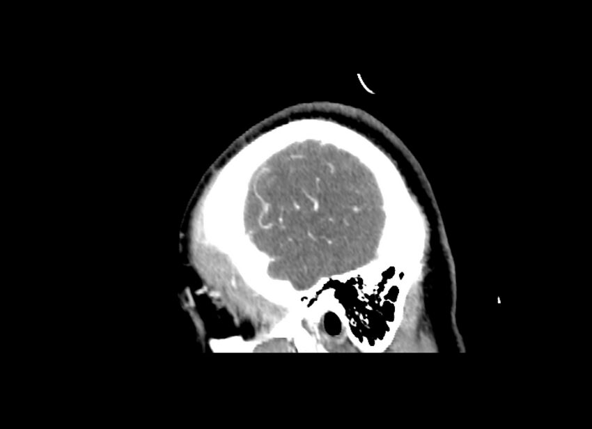 Cerebral edema (Radiopaedia 82519-96661 D 47).jpg