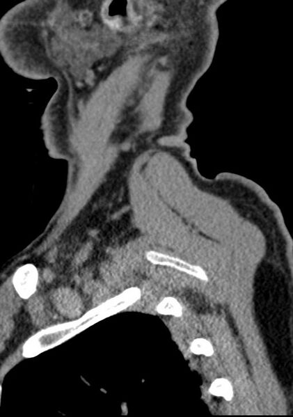 File:Cerebral hemorrhagic contusions and cervical spine fractures (Radiopaedia 32865-33841 G 13).jpg
