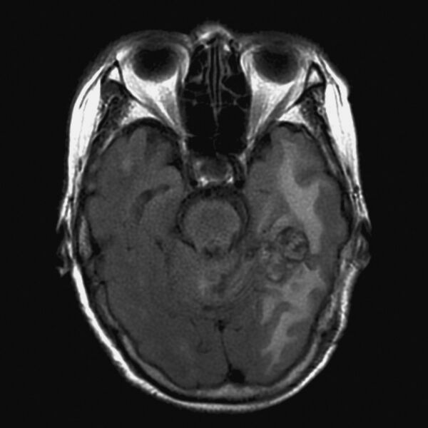 File:Cerebral radiation necrosis (Radiopaedia 7248-8188 Axial FLAIR 1).jpg