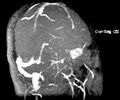 Cerebral venous infarction (Radiopaedia 10746-11206 MRV 1).JPG