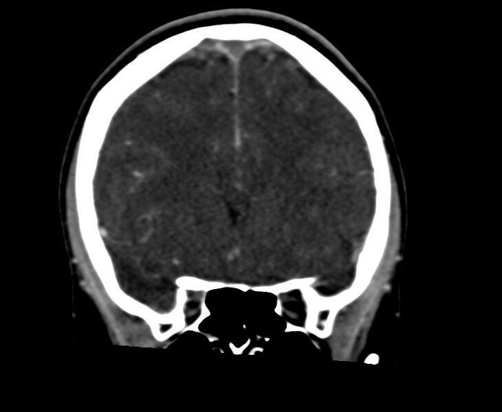 File:Cerebral venous sinus thrombosis (Radiopaedia 59224-66646 Coronal C+ delayed 24).jpg