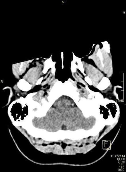 File:Cerebral venous sinus thrombosis (Radiopaedia 91329-108965 Axial non-contrast 7).jpg