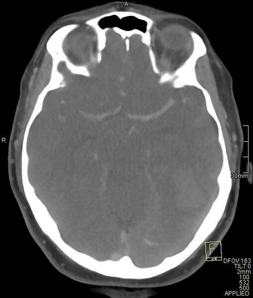File:Cerebral venous sinus thrombosis (Radiopaedia 91329-108965 Axial venogram 34).jpg