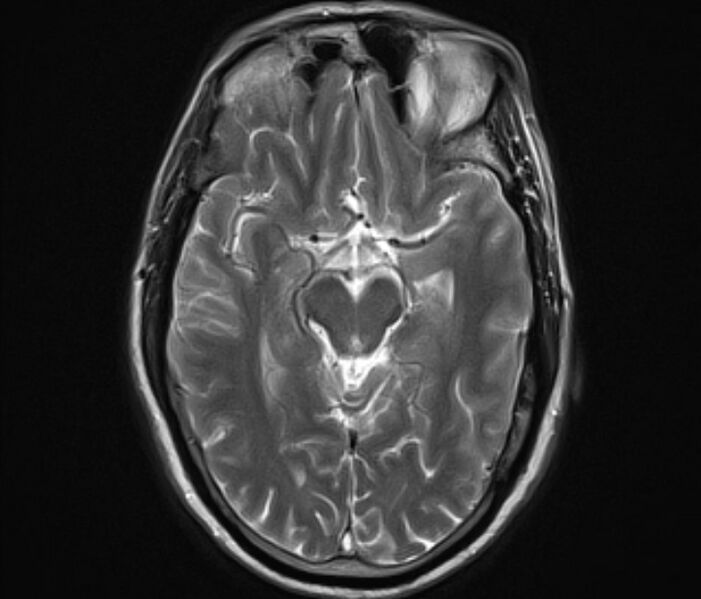File:Cerebral venous thrombosis (Radiopaedia 71207-81504 Axial T2 12).jpg