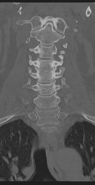 File:Cervical canal stenosis due to ossification of the posterior longitudinal ligament (Radiopaedia 47260-51823 Coronal bone window 22).png