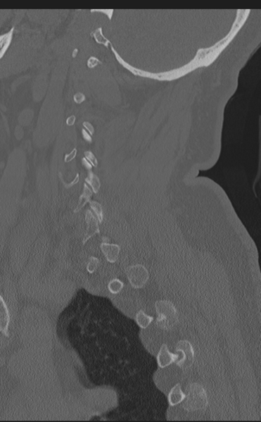 File:Cervical canal stenosis due to ossification of the posterior longitudinal ligament (Radiopaedia 47260-51823 Sagittal bone window 57).png