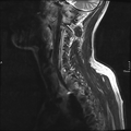 Cervical dural CSF leak on MRI and CT treated by blood patch (Radiopaedia 49748-54995 Sagittal T2 1).png
