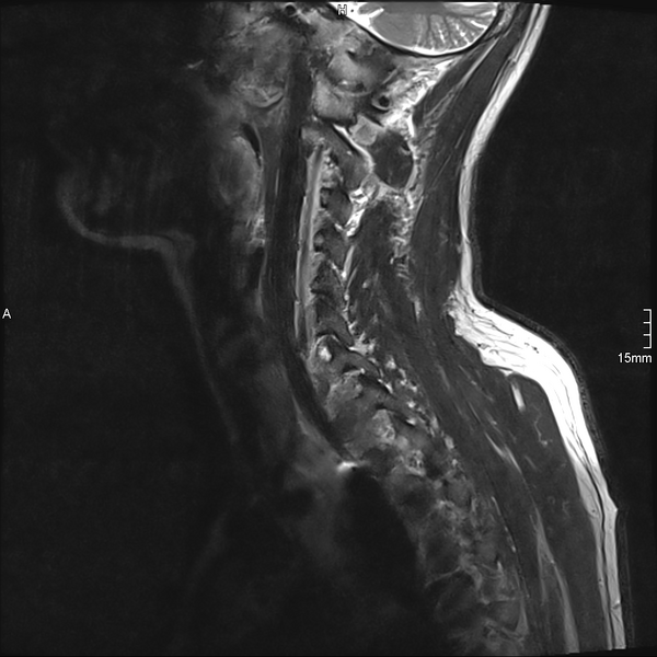 File:Cervical dural CSF leak on MRI and CT treated by blood patch (Radiopaedia 49748-54995 Sagittal T2 1).png