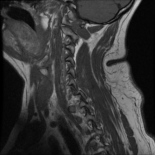File:Cervical fracture and dislocation with locked facet (Radiopaedia 31837-32781 Sagittal T1 13).jpg