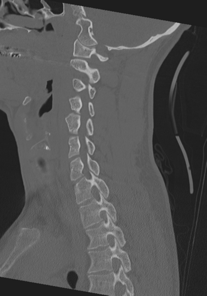 File:Cervical intercalary bone (Radiopaedia 35211-36748 Sagittal bone window 32).png