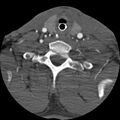 Cervical spine fractures with vertebral artery dissection (Radiopaedia 32135-33078 D 26).jpg