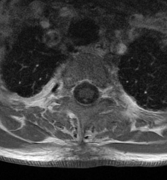 File:Cervical spondylodiscitis (Radiopaedia 81362-95110 Axial T1 C+ fat sat 22).jpg