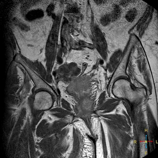 File:Cervical stump squamous cell carcinoma (Radiopaedia 48049-52858 Coronal T1 C+ 6).jpg