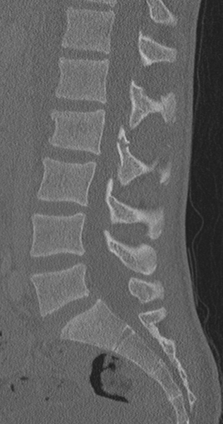 File:Chance fracture (Radiopaedia 40360-42912 Sagittal bone window 54).png