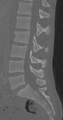 Chance fracture (Radiopaedia 40360-42912 Sagittal bone window 54).png