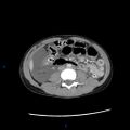 Chance fracture with duodenal and pancreatic lacerations (Radiopaedia 43477-46864 A 23).jpg