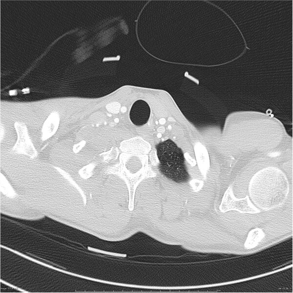 File:Chest and abdomen multi-trauma (Radiopaedia 26294-26425 lung window 13).jpg