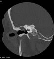 Cholesteatoma (Radiopaedia 5467-7197 Coronal bone window 7).jpg