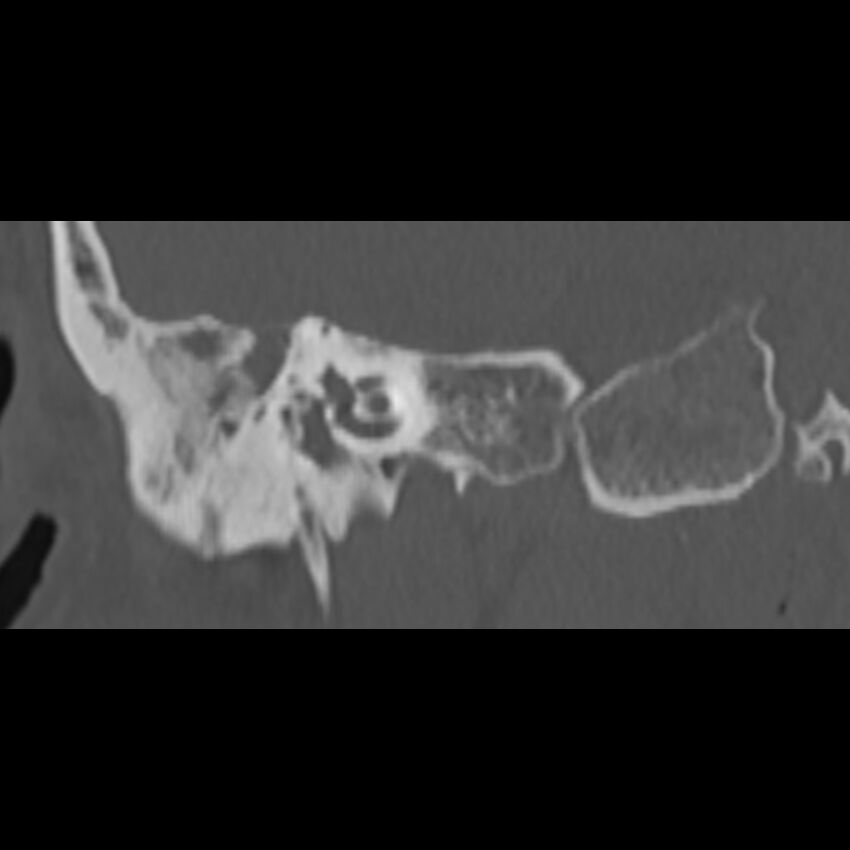 Cholesteatoma (Radiopaedia 68176-77673 Coronal bone window 41).jpg