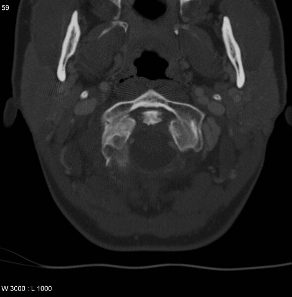 File:Chondroblastoma - occipital condyle (Radiopaedia 5569-7304 bone window 12).jpg