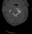 Chordoma (C4 vertebra) (Radiopaedia 47561-52188 Axial bone window 23).png