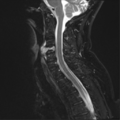 Chordoma (C4 vertebra) (Radiopaedia 47561-52189 Sagittal T2 fat sat 6).png