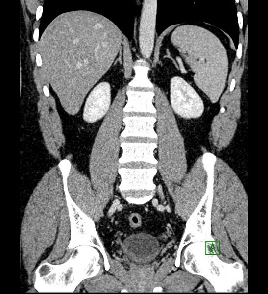 File:Chromophobe renal cell carcinoma (Radiopaedia 84286-99573 H 117).jpg