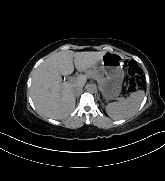 File:Chromophobe renal cell carcinoma (Radiopaedia 84290-99582 Axial non-contrast 36).jpg
