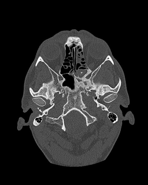 File:Chronic maxillary sinusitis caused by a foreign body (Radiopaedia 58521-65676 Axial bone window 196).jpg