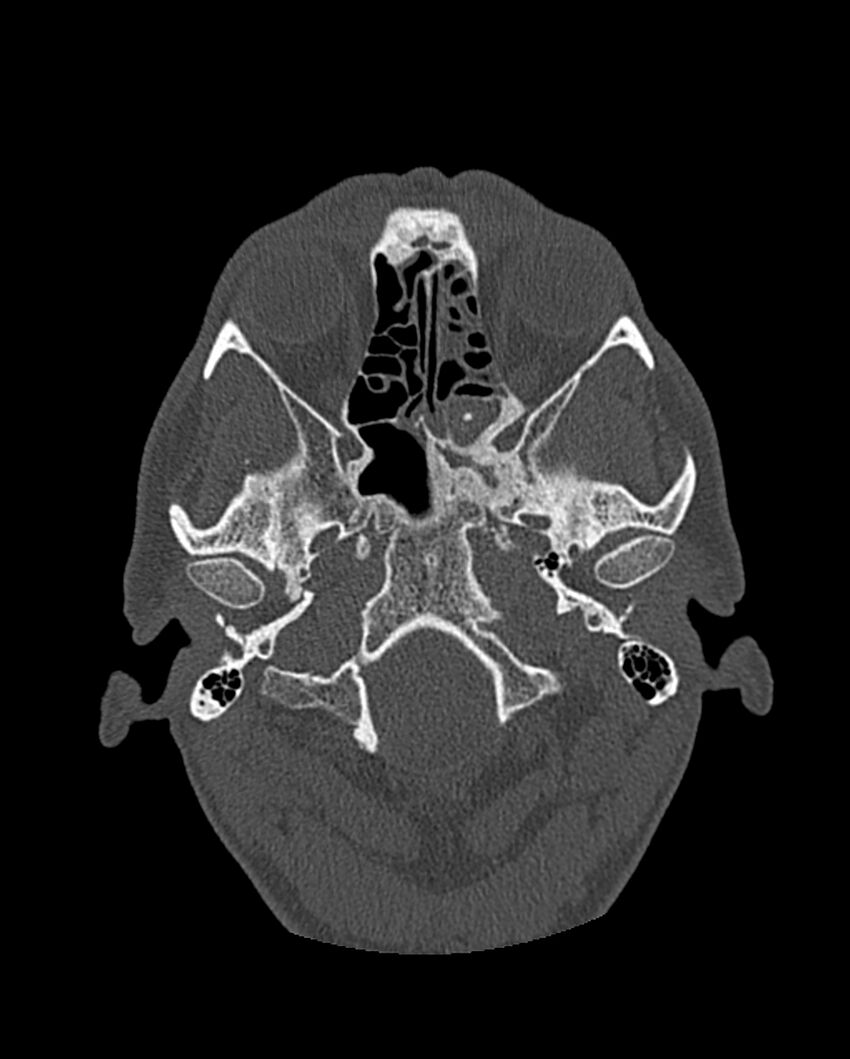 Chronic maxillary sinusitis caused by a foreign body (Radiopaedia 58521-65676 Axial bone window 197).jpg