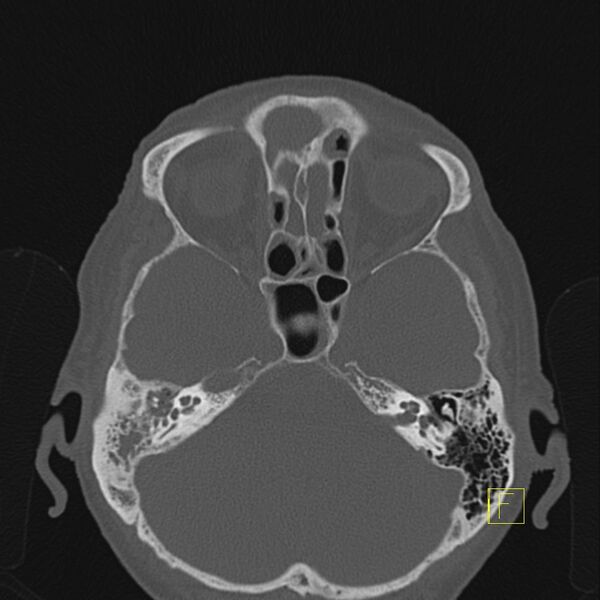 File:Chronic otitis media (Radiopaedia 14994-14912 Axial bone window 9).JPEG