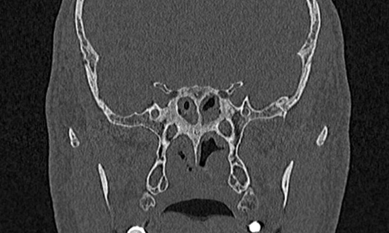 File:Chronic rhinosinusitis (Radiopaedia 65079-74075 Coronal bone window 65).jpg