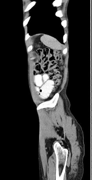 File:Chronic small bowel volvulus (Radiopaedia 75224-86322 C 21).jpg