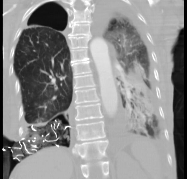 File:Clagett thoracotomy with bronchopleural fistula (Radiopaedia 29192-29587 Coronal lung window 9).jpg