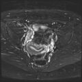 Class II Mullerian duct anomaly- unicornuate uterus with rudimentary horn and non-communicating cavity (Radiopaedia 39441-41755 Axial T2 fat sat 15).jpg