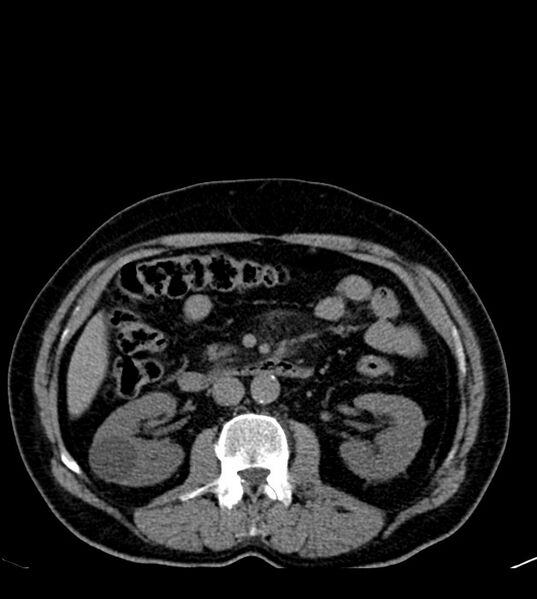 File:Clear cell renal cell carcinoma (Radiopaedia 85006-100539 Axial non-contrast 39).jpg