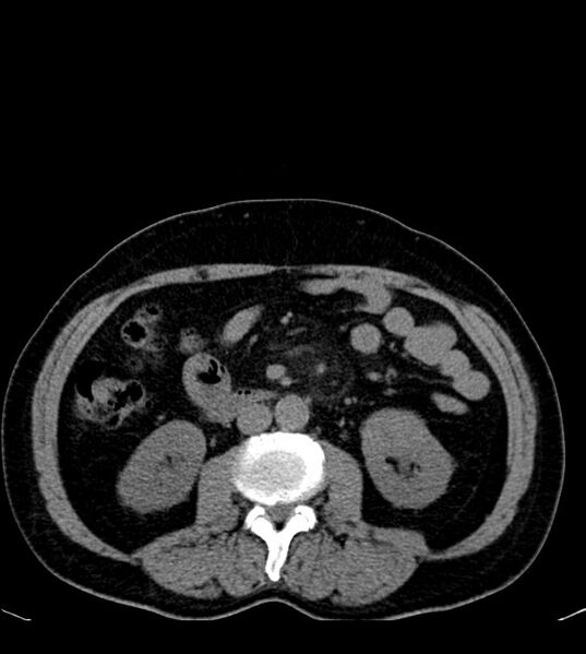 File:Clear cell renal cell carcinoma (Radiopaedia 85006-100539 Axial non-contrast 44).jpg