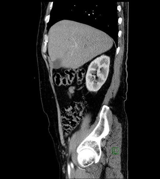 File:Clear cell renal cell carcinoma (Radiopaedia 85006-100539 E 46).jpg