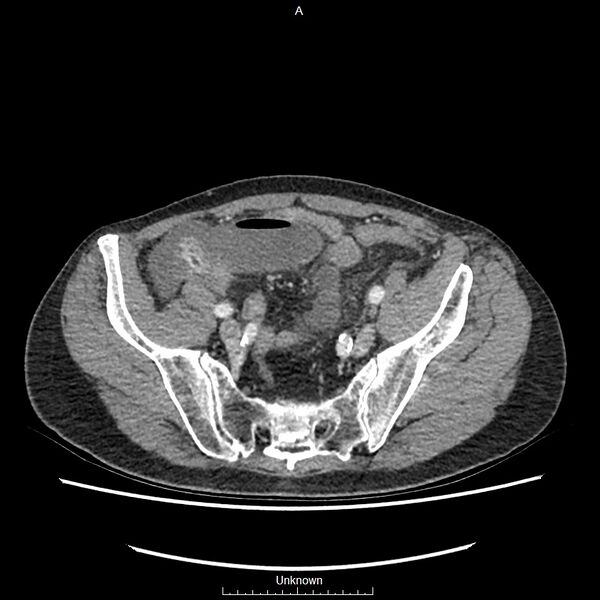 File:Closed loop bowel obstruction and ischemia (Radiopaedia 86959-103180 A 69).jpg