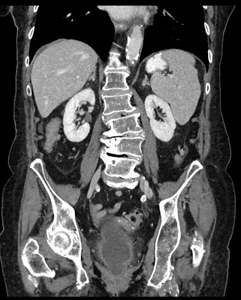 File:Closed loop small bowel obstruction - adhesions (Radiopaedia 59269-66611 B 76).jpg