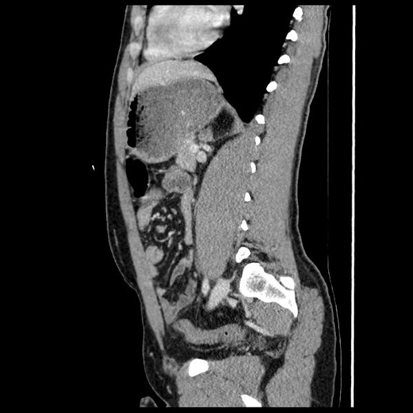 File:Co-existing acute appendicitis and epiploic appendagitis (Radiopaedia 61789-69911 B 59).jpg