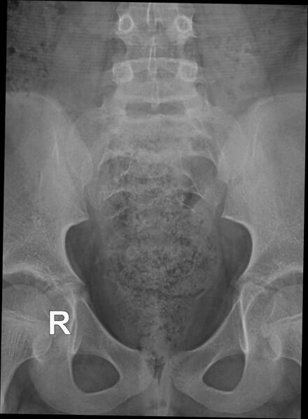 File:Coccyx fracture (Radiopaedia 68051-77520 Frontal 1).jpg