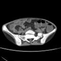 Colocolic fistula - Crohn disease (Radiopaedia 57063-63955 A 60).jpg