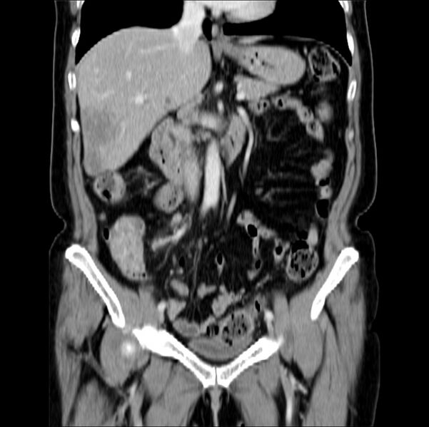 File:Colon carcinoma with hepatic metastases (Radiopaedia 29477-29961 B 20).jpg