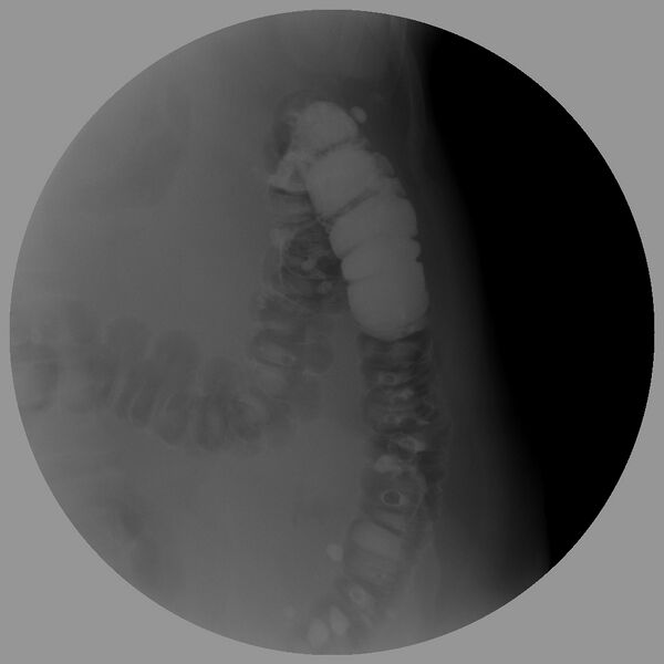 File:Colonic diverticulosis on single and double contrast barium enema (Radiopaedia 42254-45340 Double contrast 4).jpg