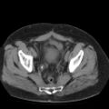 Colonic fistula (Radiopaedia 16047-15707 Axial non-contrast 55).jpg