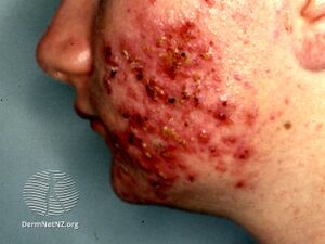 Gram negative folliculitis (DermNet NZ acne-gramneg).jpg