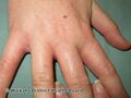 Hand dermatitis (DermNet NZ contact-dermatitis-isocyanate-03).jpg