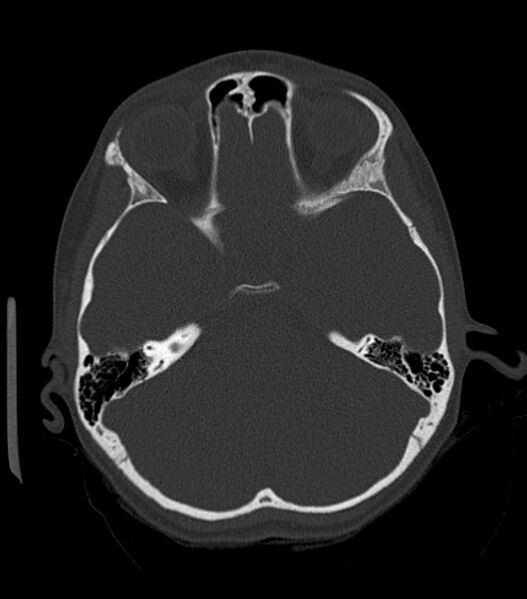 File:Nasoorbitoethmoid fracture (Radiopaedia 90044-107205 Axial bone window 87).jpg